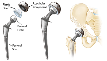 Best Hip and knee surgeon in cheshire